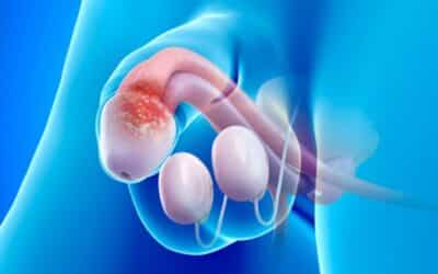 VPH: Uno de los principales factores de riesgo para desarrollar cáncer de pene