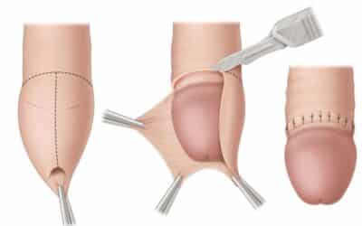 Dudas sobre la circuncisión