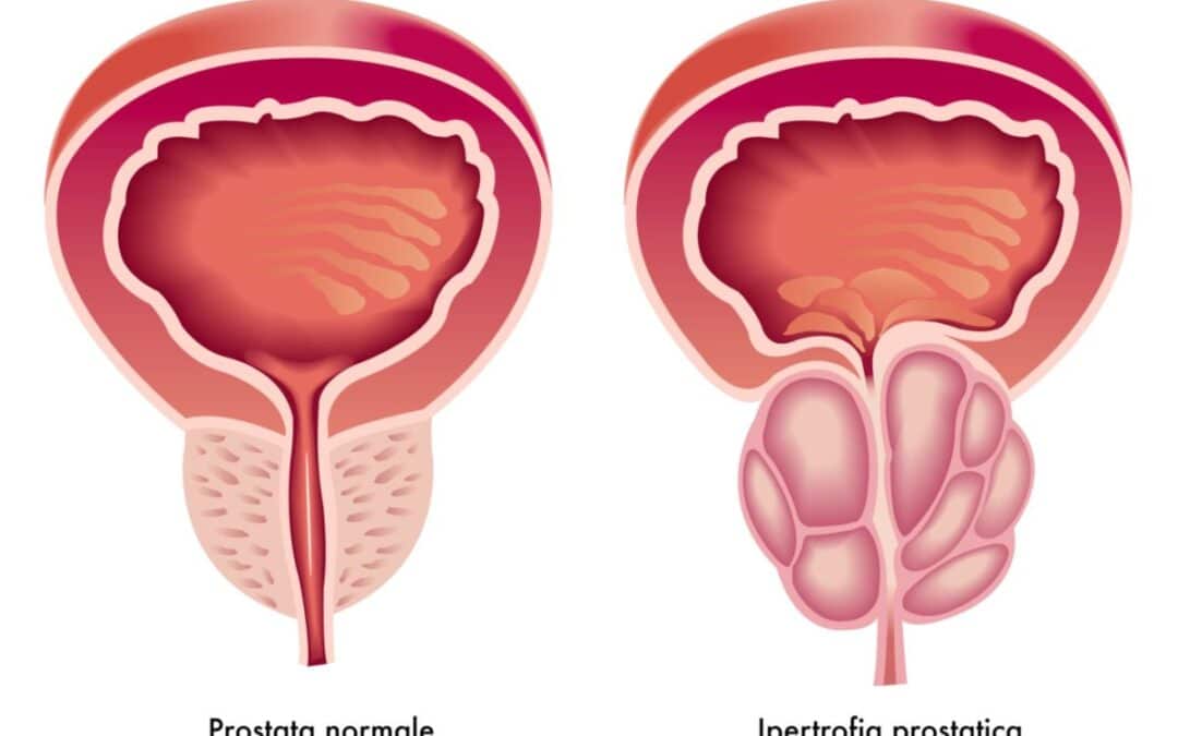 Crecimiento prostático síntomas