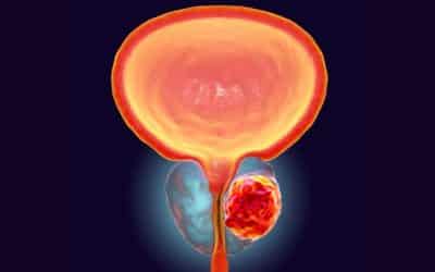 Cómo prevenir el cáncer de próstata
