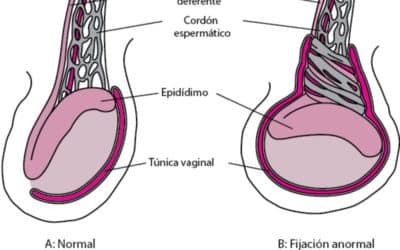 Causas de una torsión testicular