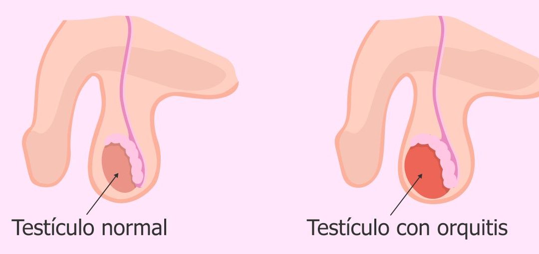 causa de la hinchazón testicular