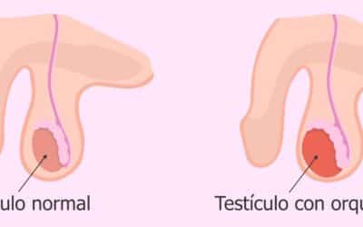 Orquitis: causa de la hinchazón testicular