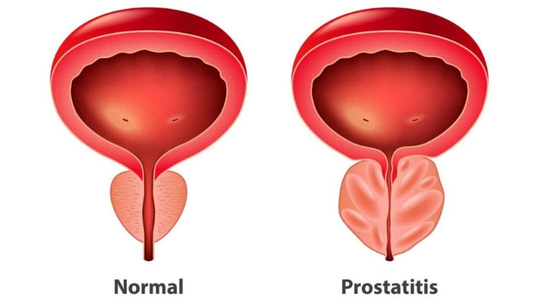 prostatitis crónica y aguda