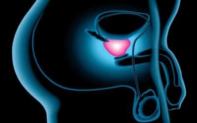 ¿Qué provoca cáncer de próstata?